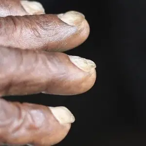 Kuku penderita anemia