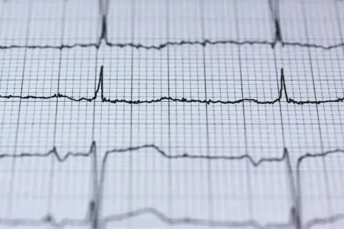 EKG SVT